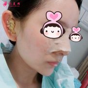 隆鼻的真實(shí)案例前后對(duì)比圖：恢復(fù)7-30天效果記錄！