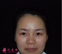 北京葉子整形魯禮新做的雙眼皮 術(shù)后60天效果對(duì)比真的很不錯(cuò)