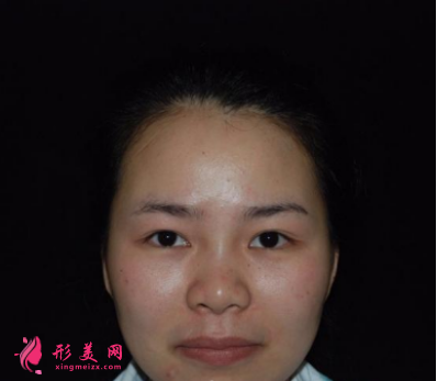找北京葉子整形魯禮新做的雙眼皮 術(shù)后60天效果對比真的很不錯(cuò)
