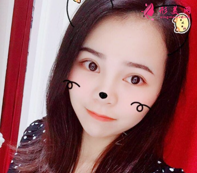 找北京葉子整形魯禮新做的雙眼皮 術(shù)后60天效果對比真的很不錯(cuò)