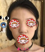 上海華美剛做完隆鼻真實(shí)案例，迫不及待的想給大家分享