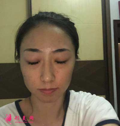 劉喆醫(yī)生為我做的白瓷娃娃項(xiàng)目 術(shù)后第7天效果圖分享