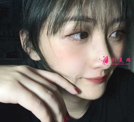 西安交大附屬二院整形科隆鼻90天恢復(fù)效果分享