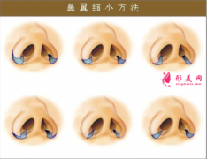 做鼻翼縮小的效果如何？