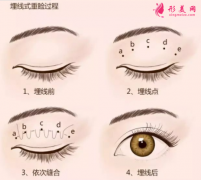 雙眼皮埋線后會脫落嗎？