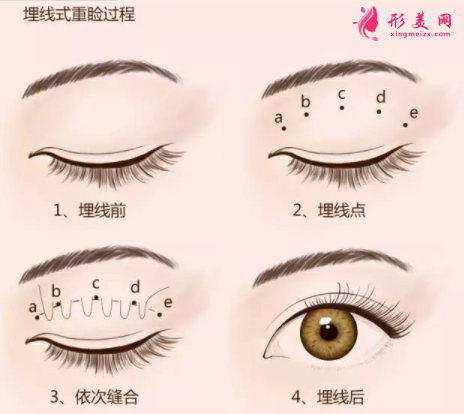 雙眼皮埋線后會脫落嗎