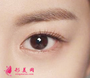 開眼角后怎么快速恢復