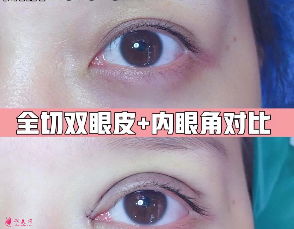 北京克萊美舍張冰潔眼綜合案例