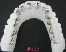 舌側(cè)內(nèi)矯正牙齒到底好不好？矯正牙齒優(yōu)點盤點