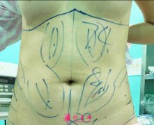 成都玉之光腰部吸脂案例，術(shù)后恢復(fù)記錄分享~