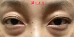 什么是眼袋？祛眼袋有哪些優(yōu)勢呢？
