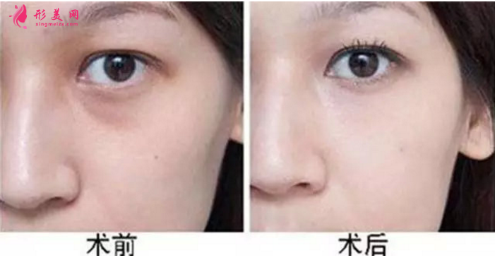 什么是眼袋？祛眼袋有哪些優(yōu)勢呢？