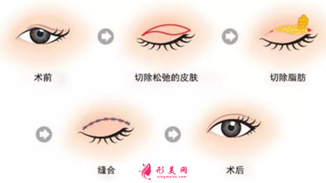 什么是眼袋？祛眼袋有哪些優(yōu)勢呢？