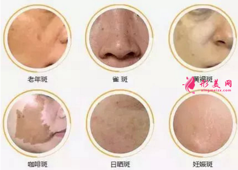 什么是皮秒祛斑？與其他有何對比？