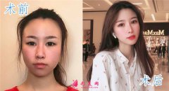 溫州和平整形醫(yī)院雙眼皮術(shù)后效果， 案例分享