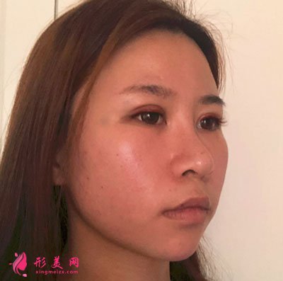 溫州和平整形醫(yī)院雙眼皮手術(shù)案例