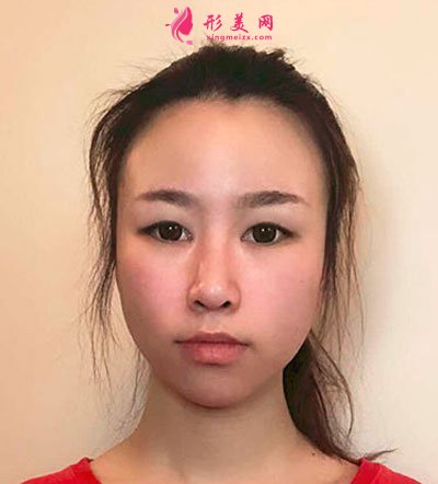 溫州和平整形醫(yī)院雙眼皮手術(shù)案例