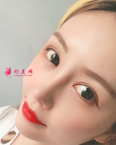 成都菲格隆鼻手術案例