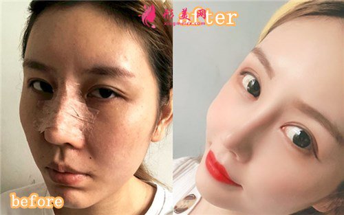 成都菲格隆鼻手術案例