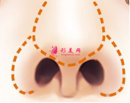 鼻翼縮小手術(shù)修復(fù)多少錢