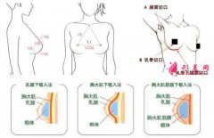 硅膠隆胸手術(shù)疼嗎？疼痛時間維持多久？