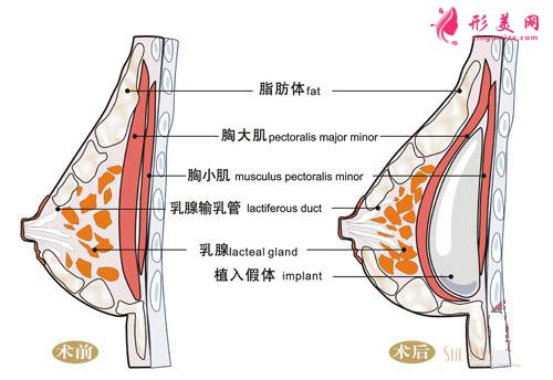 硅膠隆胸手術疼嗎？疼痛時間維持多久？