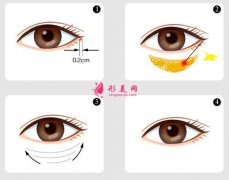 溶脂去眼袋價(jià)格是多少錢？適合多大年齡的人？