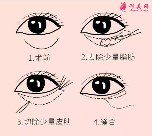溶脂去眼袋價格是多少錢？適合多大年齡的人？