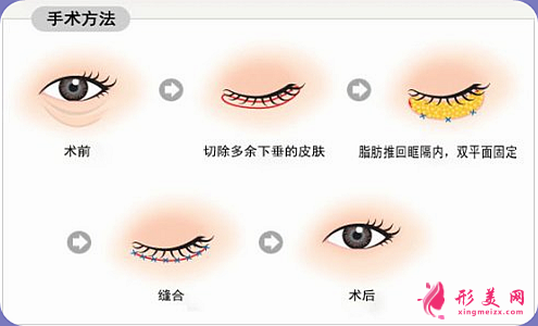 溶脂去眼袋價格是多少錢？適合多大年齡的人？
