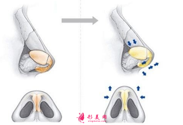 解讀鼻尖縮小整形手術(shù)，術(shù)后注意事項大全~