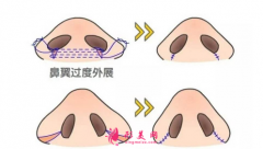 解讀鼻尖縮小整形手術(shù)，術(shù)后注意事項大全~