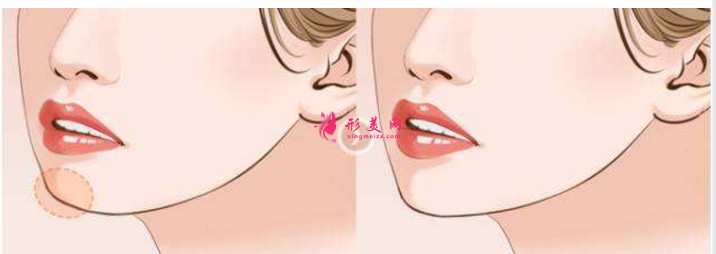 磨下巴整形風(fēng)險(xiǎn)有多大？該如何避免？