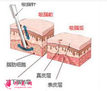 腿吸脂費用
