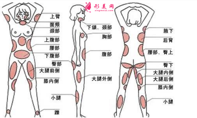 腿吸脂費用
