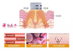 面部光子嫩膚能帶來(lái)哪些效果？需要做多少錢(qián)次