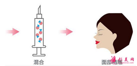 【術(shù)前科普】自體脂肪填充安全嗎？多久可以恢復(fù)