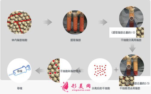 【術(shù)前科普】自體脂肪填充安全嗎？多久可以恢復(fù)