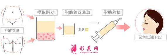 【術(shù)前科普】自體脂肪填充安全嗎？多久可以恢復(fù)