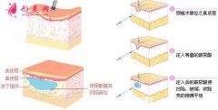 打玻尿酸要多少錢？術(shù)后注意事項(xiàng)大全~