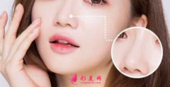 上海華美整形醫(yī)院鼻翼縮小手術(shù)修復(fù)多少錢？