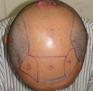 上海整形醫(yī)院fue植發(fā)技術(shù)要多少錢?需要注意哪些事項(xiàng)呢?