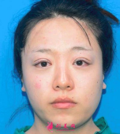 北京百達(dá)麗眼部修復(fù)案例
