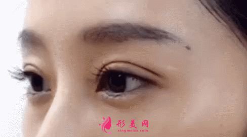 雙眼皮術(shù)前的準(zhǔn)備需要做什么