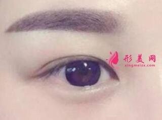 做開眼角手術(shù)一般需要多少錢
