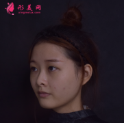 成都成美整形醫(yī)院王立鵬做的自體軟骨隆鼻,真人案例分享