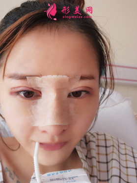 找成都成美整形醫(yī)院王立鵬做的自體軟骨隆鼻,價格_案例分享