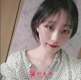 成都美萊做雙眼皮多少錢(qián)_埋線(xiàn)雙眼皮+外開(kāi)眼角怎么樣_案例效果