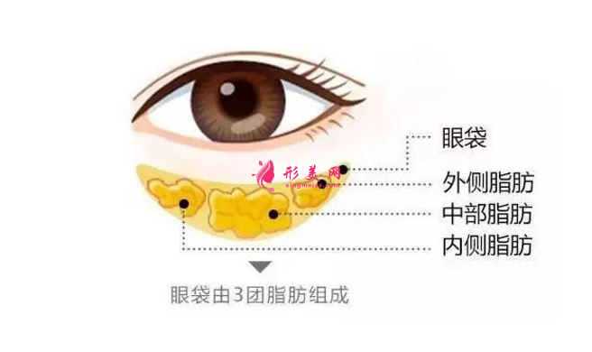 做去眼袋手術(shù)多少錢？有哪些方法？