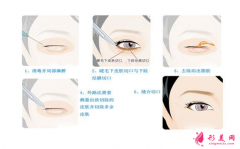 上海整形醫(yī)院做祛眼袋手術(shù)多少錢？有哪些方法？