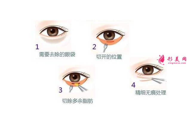 北京祛眼袋多少錢？術(shù)后恢復(fù)時(shí)間和護(hù)理掛鉤~